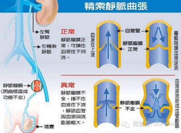 關(guān)于2021年征兵精索靜脈曲張標準的探討，2021年征兵精索靜脈曲張標準深度解析