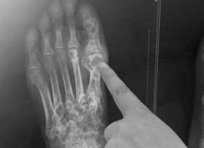 最佳痛風(fēng)治療簡介