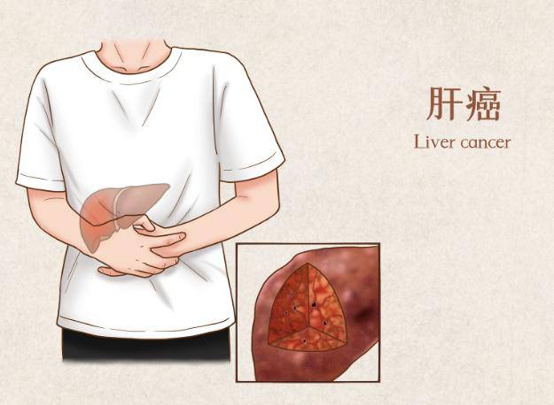 肝癌一般三處痛