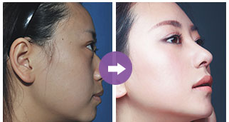 關(guān)于只做鼻翼縮小手術(shù)的費用分析，只做鼻翼縮小手術(shù)的費用詳解