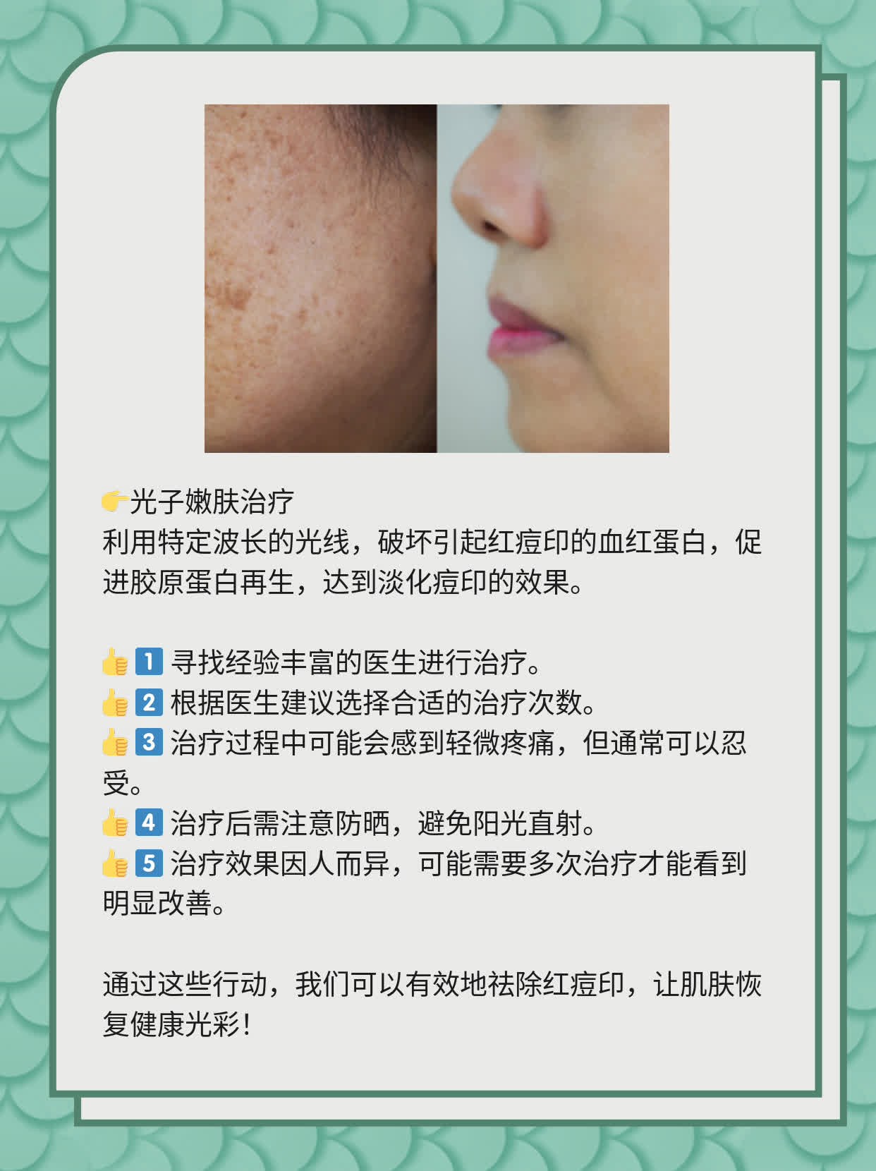 如何有效去除紅痘印，一站式解決方案，一站式解決紅痘印問(wèn)題，有效去除方法大全