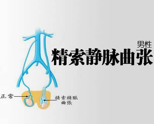精索靜脈曲張的癥狀表現(xiàn)及其影響，精索靜脈曲張的癥狀表現(xiàn)及其潛在影響