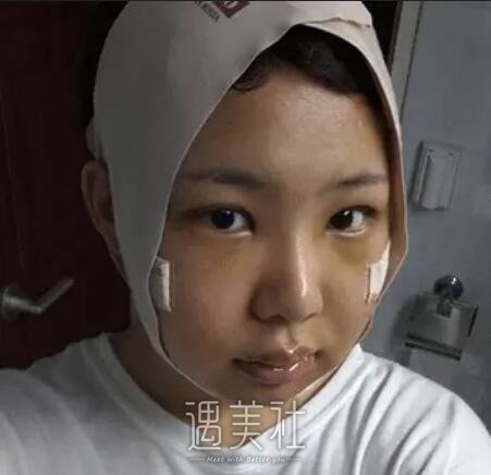 磨骨一年后的驚人變化，對比照片揭示細節(jié)，磨骨一年后的驚人變化，細節(jié)對比揭示驚人效果