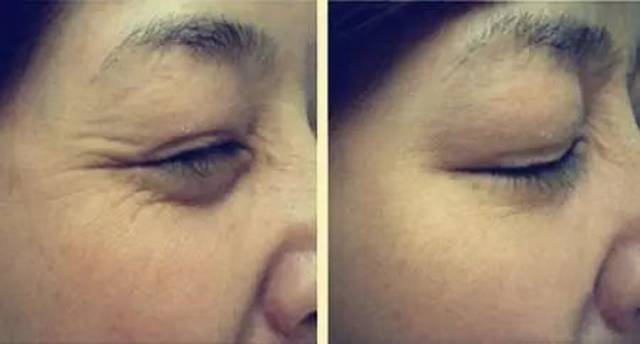 肉毒素除皺的副作用深度解析，肉毒素除皺副作用深度解析