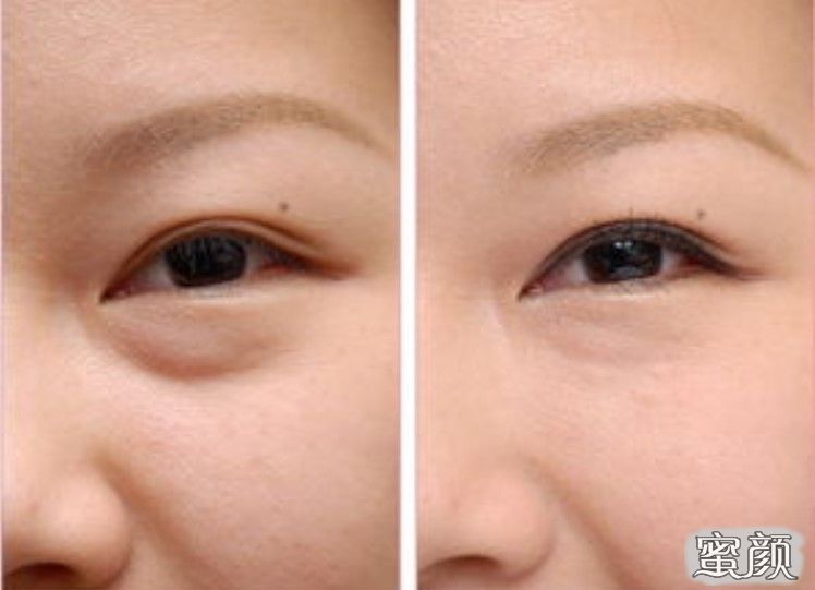 如何消除眼袋，簡(jiǎn)單實(shí)用的方法，消除眼袋的實(shí)用方法與技巧