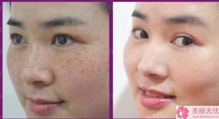 怎樣祛斑又快又有效，全面解析祛斑方法與技巧，全面解析，快速有效的祛斑方法與技巧