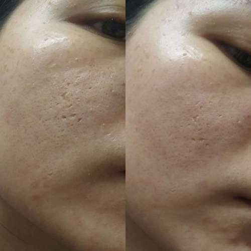 祛痘坑最好的方法，目前最有效的解決方案，最有效的祛痘坑方法，當前最受歡迎的解決方案