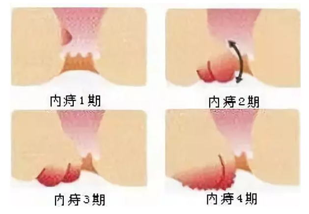 怎樣判斷自己是否患有痔瘡？全面解析與指導，如何判斷自己是否患有痔瘡？詳細解析及指導指南