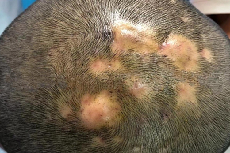 毛囊炎硬疙瘩圖片，了解、識(shí)別與治療，毛囊炎硬疙瘩詳解，識(shí)別圖片、了解與治療