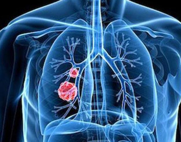 肺部感染恢復(fù)時(shí)間解析，多久能夠康復(fù)？，肺部感染恢復(fù)時(shí)間解析，多久可康復(fù)？