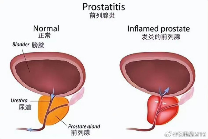 前列腺炎的最佳治療方法探討，前列腺炎最佳治療方法探討與解析