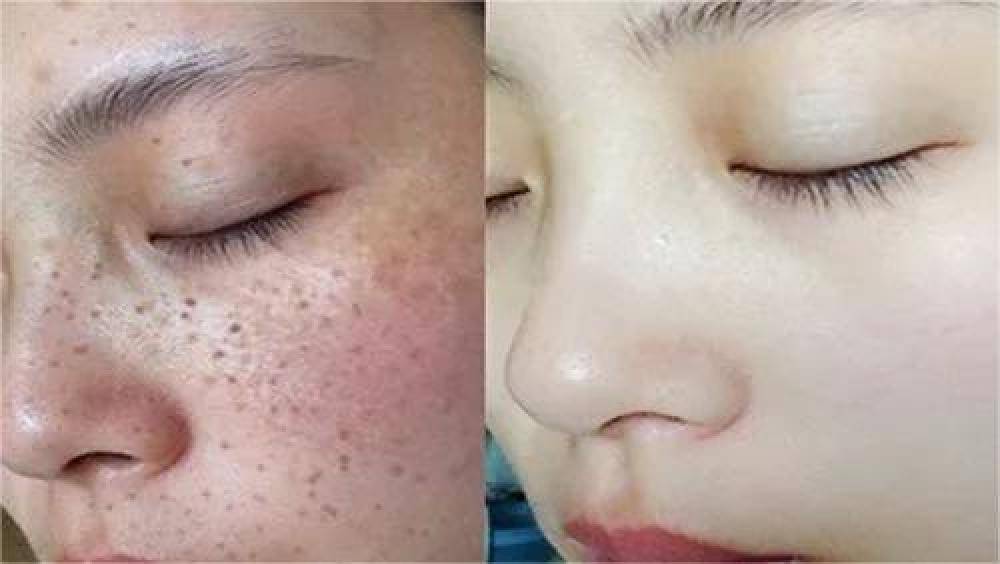 哪種祛斑方法最有效不反彈，全面解析最有效的祛斑途徑，全面解析，最有效的祛斑方法，不反彈之選！
