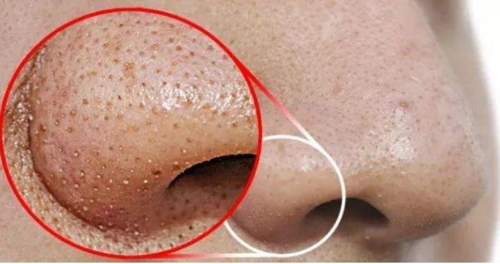 孩子身上起螨蟲疙瘩圖片，了解、預防與治療，孩子身上的螨蟲疙瘩，圖片、預防與治療全攻略