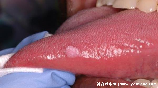 關(guān)于HPV感染舌頭初期的圖片及其相關(guān)解析，HPV感染舌頭初期癥狀圖片與解析