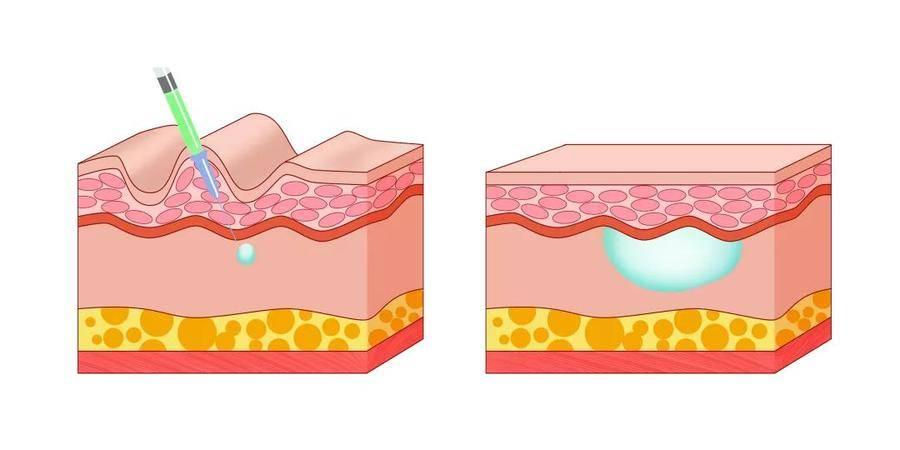 法令紋去除最安全永久的方法，全面解析與實用建議，全面解析法令紋永久安全去除法，實用建議與最佳實踐