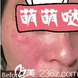 去紅血絲激光手術(shù)費用詳解，多少錢？，激光去紅血絲手術(shù)費用全面解析，費用究竟是多少？