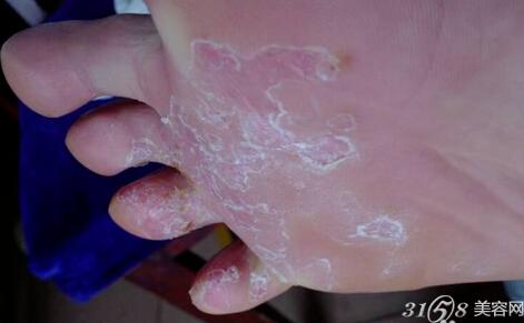 腳脫皮怎么辦？藥物治療推薦與護(hù)理建議，腳脫皮解決方法，藥物治療推薦及護(hù)理建議