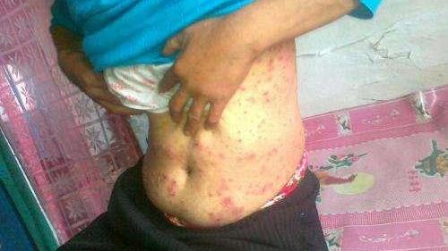 男生下面流膿，原因、應(yīng)對(duì)措施與健康提醒，男性私處流膿，原因、應(yīng)對(duì)與健康警示