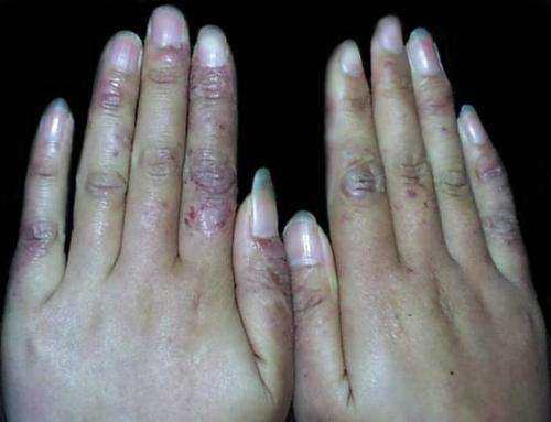 根治凍瘡，預(yù)防復(fù)發(fā)，全面解析凍瘡的治療方法，根治凍瘡，預(yù)防復(fù)發(fā)，全面解析凍瘡治療策略