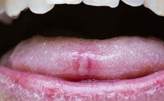 口腔粘膜炎癥，深入了解與治療策略，口腔粘膜炎癥，全面解析與治療指南