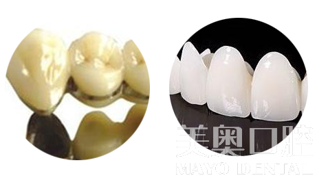 烤瓷牙和全瓷牙的利與弊，深度解析，深度解析，烤瓷牙與全瓷牙的優(yōu)缺點(diǎn)對比