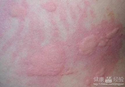 風疹是怎么引起的，風疹的成因解析