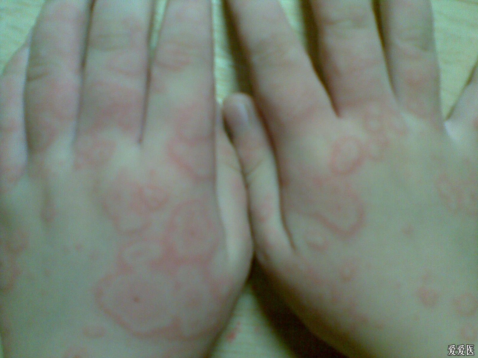 關(guān)于螨蟲過敏圖片與澳彩資料的查詢，來自94848.cσm的詳盡資源，螨蟲過敏圖片與澳彩資料查詢，詳盡資源來自94848.cσm