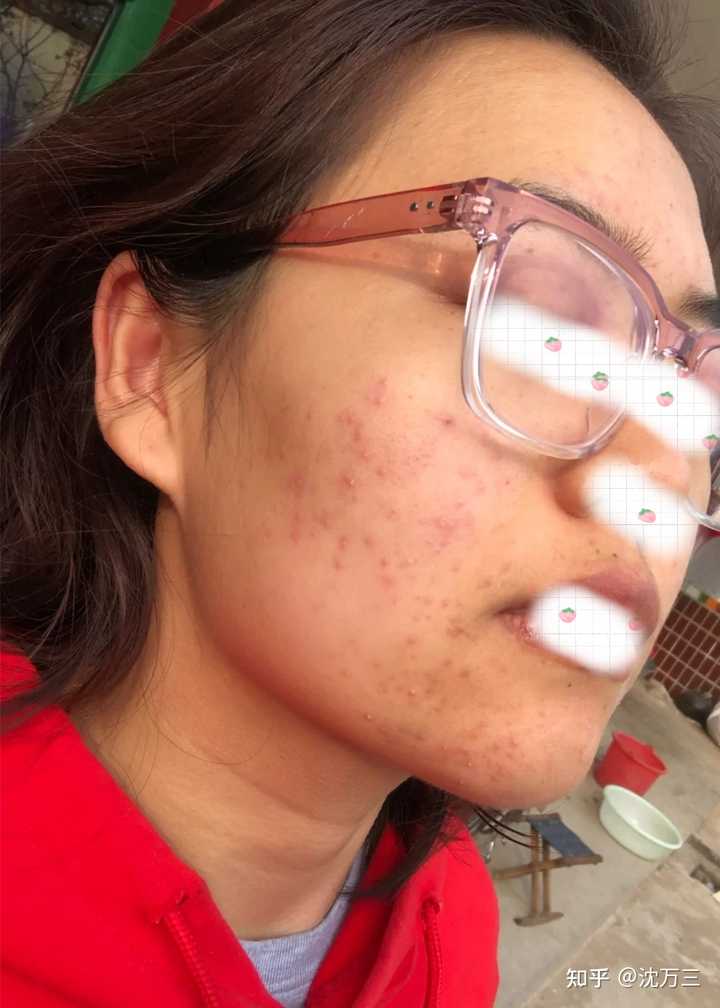 消除痤瘡留下的紅色痘印的有效方法，消除紅色痘印，痤瘡后的護膚秘訣