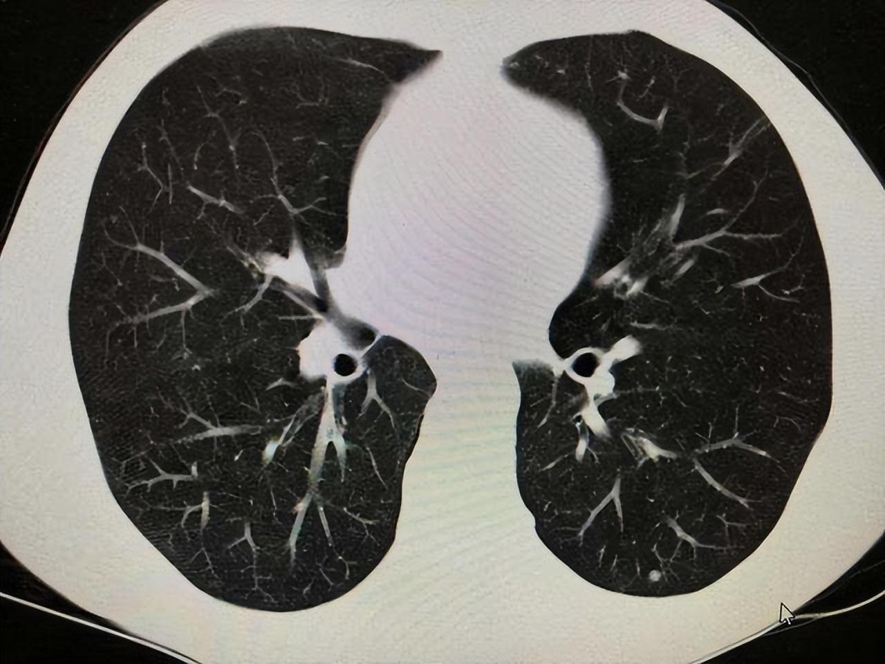 關(guān)于打科興后出現(xiàn)肺結(jié)節(jié)的探討，科興疫苗接種與肺結(jié)節(jié)關(guān)系探討