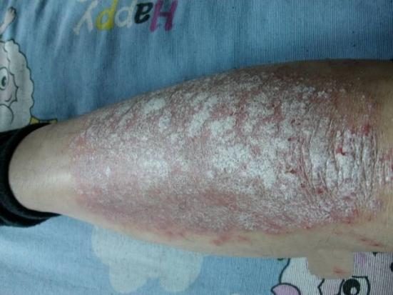 銀屑病初期癥狀圖片解析，了解銀屑病從初始階段開始，銀屑病初期癥狀詳解，圖片解析助你早期識別銀屑病