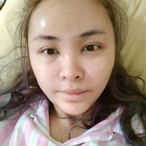 脂肪填充五年后可能出現(xiàn)的后遺癥，脂肪填充五年后可能出現(xiàn)的后遺癥及預防措施