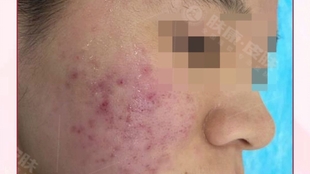 治療痤瘡的費(fèi)用分析，了解花費(fèi)多少以及背后的因素，治療痤瘡的費(fèi)用詳解，了解花費(fèi)背后的因素