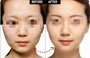 全面解析，瘦臉針價(jià)格及其相關(guān)因素，全面解析瘦臉針價(jià)格及其相關(guān)影響因素