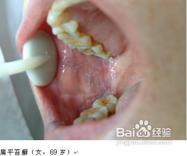 口腔扁平苔蘚，了解、預(yù)防與治療，口腔扁平苔蘚，了解、預(yù)防與治療全攻略