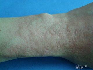 蕁麻疹患者的壽命，了解與應(yīng)對蕁麻疹的關(guān)鍵知識，蕁麻疹患者的壽命影響及應(yīng)對關(guān)鍵知識解析